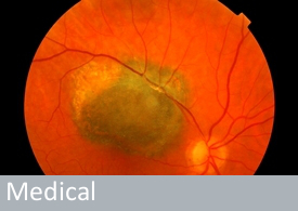 MEDICAL Retinal Tumour Bob Tapper ASIS FRPS Title