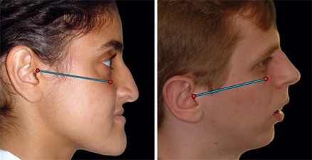 Head Alignment