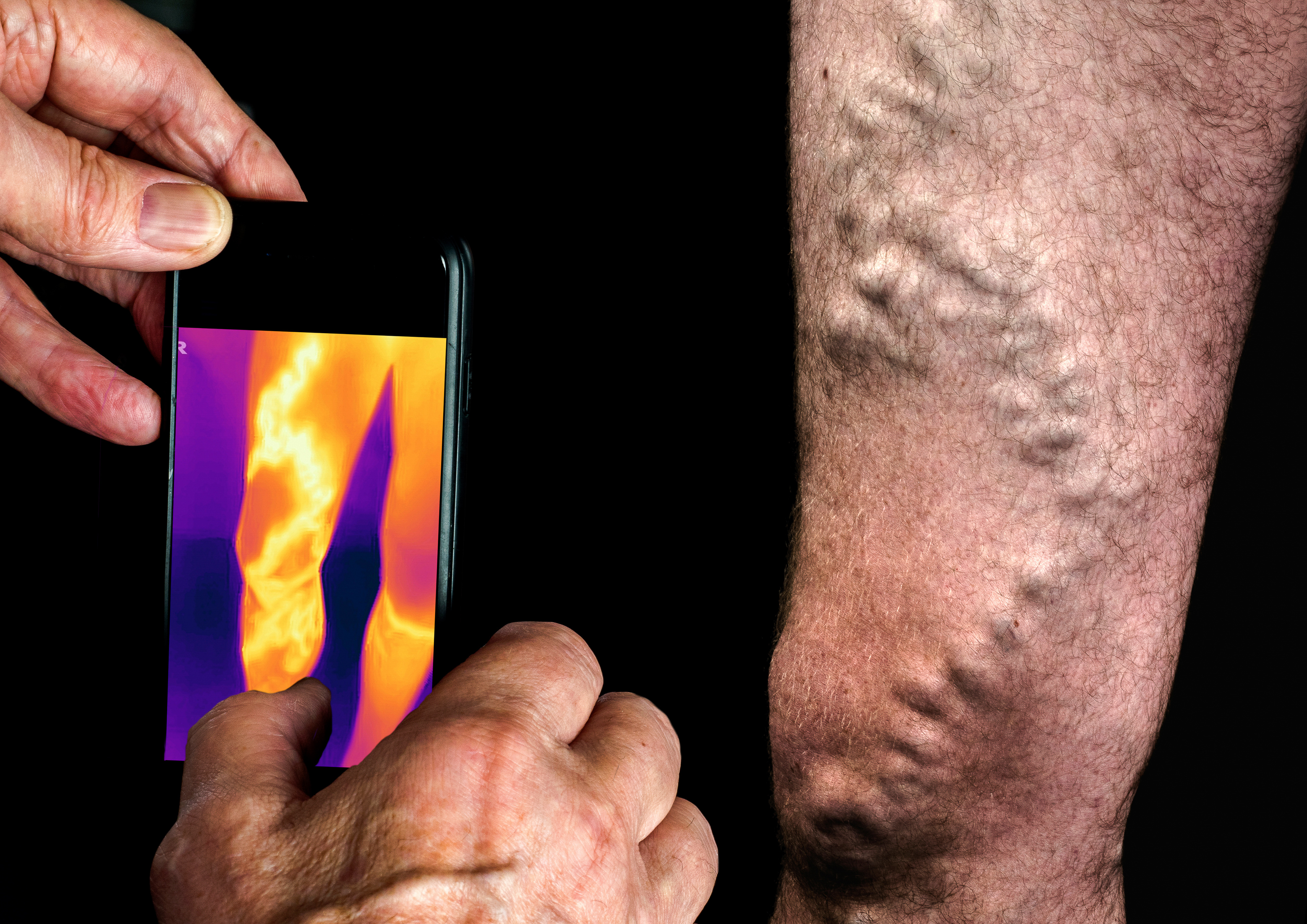 Finalist Thermal Imaging Varicose Veins by Marie Jones