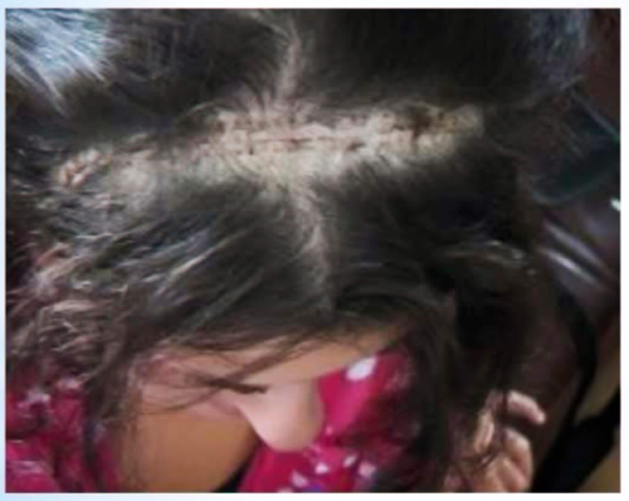 'Brain Tumour Neurosurgery Scar' By Stefania Distante ARPS