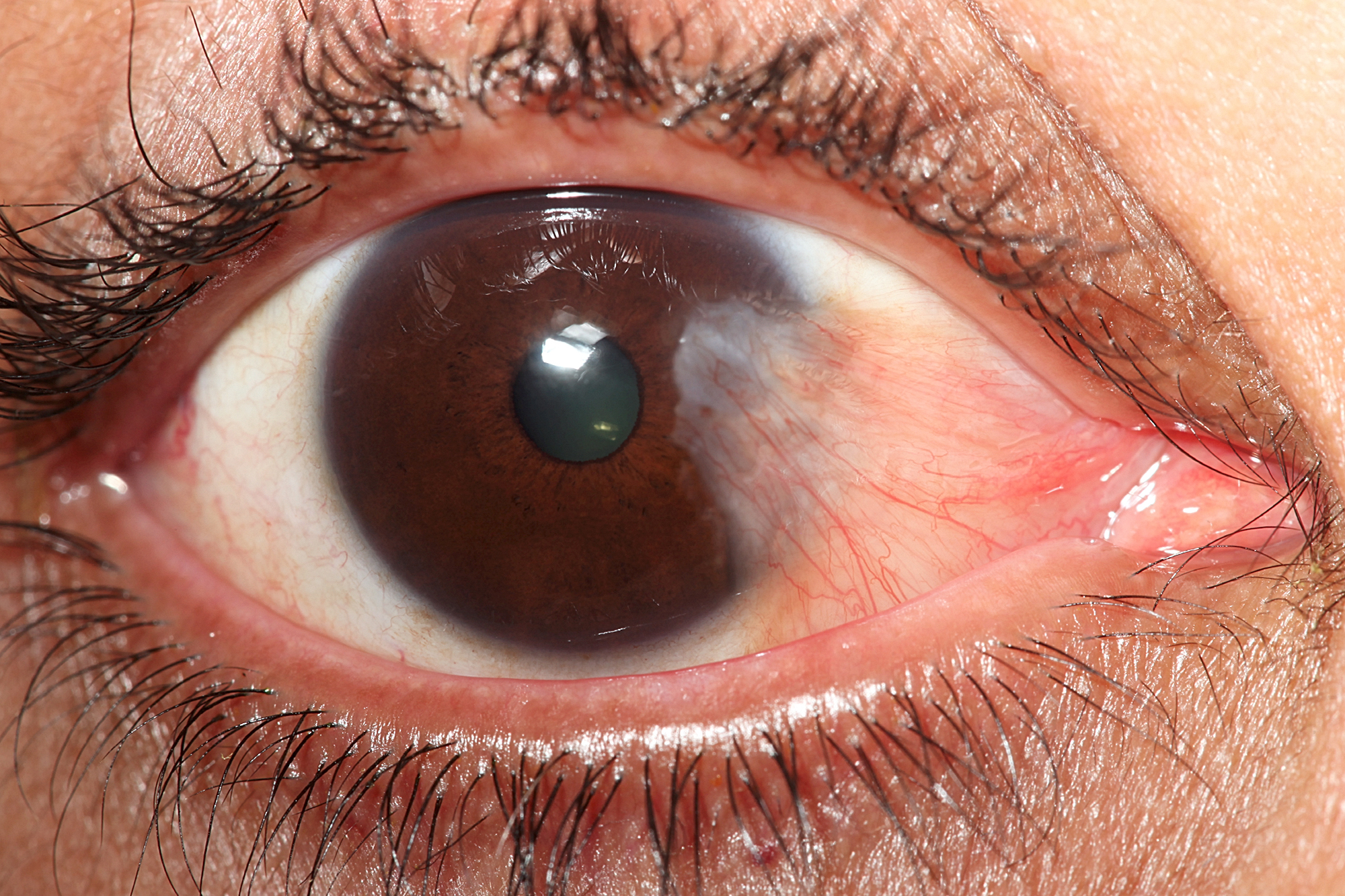 Pterygium