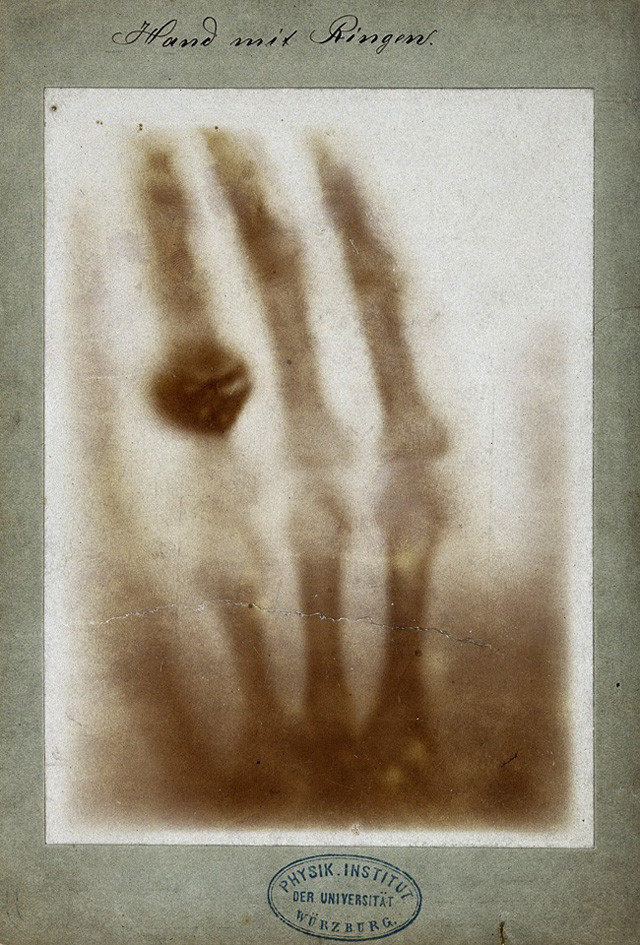 First Medical X Ray By Wilhelm Röntgen Of His Wife Anna Bertha Ludwig's Hand 1895 Wiki Commons